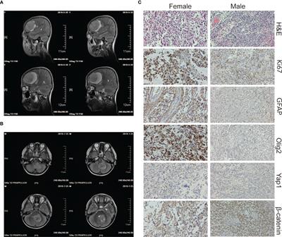 Case Report: Malignant Brain Tumors in Siblings With MSH6 Mutations